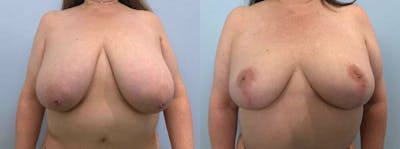 Breast Reduction Before & After Gallery - Patient 47122271 - Image 1