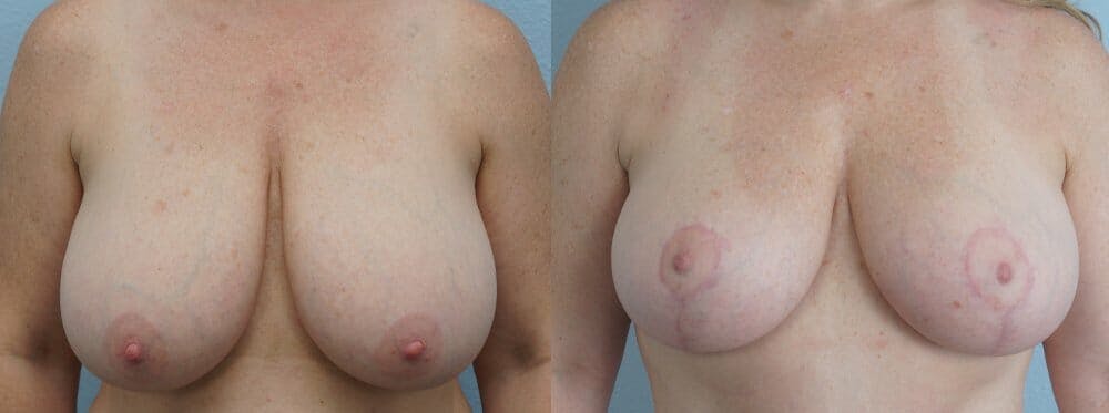 Breast Reduction