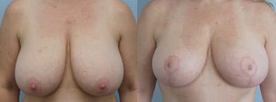 Breast Reduction Before & After Gallery - Patient 47122313 - Image 1
