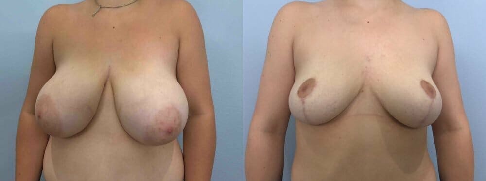 Breast Reduction
