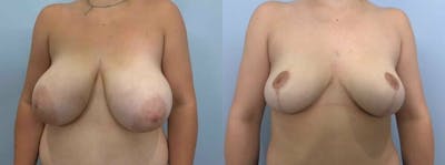 Breast Reduction Before & After Gallery - Patient 47122335 - Image 1