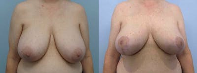Breast Reduction Before & After Gallery - Patient 47122394 - Image 1