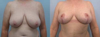 Breast Reduction Before & After Gallery - Patient 47122431 - Image 1
