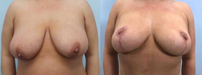 Breast Reduction Before & After Gallery - Patient 47122471 - Image 1