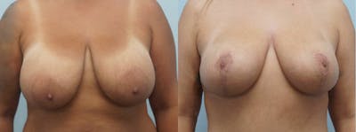 Breast Reduction Before & After Gallery - Patient 47122511 - Image 1