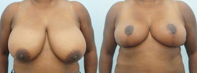 Breast Reduction Before & After Gallery - Patient 47122536 - Image 1