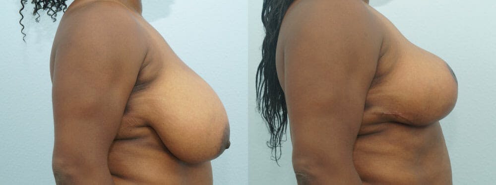 Breast Reduction Gallery - Patient 47122536 - Image 2