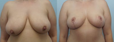 Breast Reduction Before & After Gallery - Patient 47122584 - Image 1