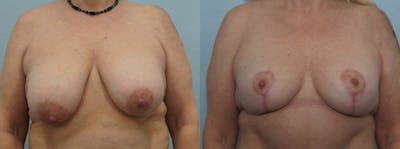 Breast Reduction Before & After Gallery - Patient 47122606 - Image 1