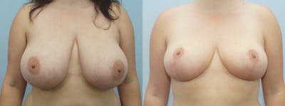 Breast Reduction Before & After Gallery - Patient 47122661 - Image 1