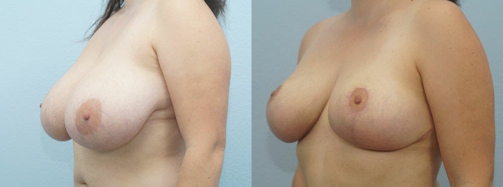 Breast Reduction Gallery - Patient 47122661 - Image 2