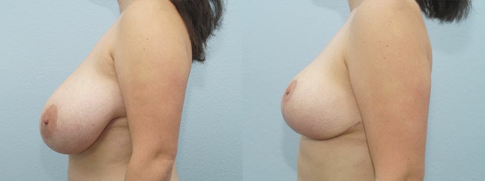 Breast Reduction Gallery - Patient 47122661 - Image 3