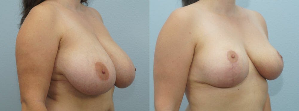 Breast Reduction Gallery - Patient 47122661 - Image 4