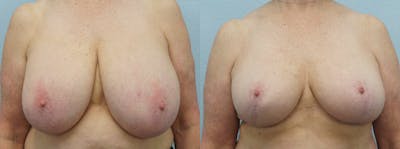 Breast Reduction Before & After Gallery - Patient 47122690 - Image 1