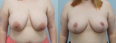 Breast Reduction Before & After Gallery - Patient 47122733 - Image 1