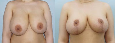Breast Reduction Before & After Gallery - Patient 47122776 - Image 1
