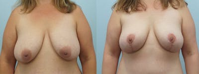 Breast Reduction Before & After Gallery - Patient 47122793 - Image 1