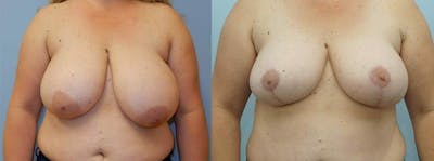 Breast Reduction Before & After Gallery - Patient 47122821 - Image 1