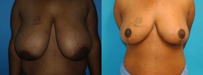 Breast Reduction Before & After Gallery - Patient 47125471 - Image 1