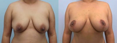 Breast Lift Gallery - Patient 47125674 - Image 1
