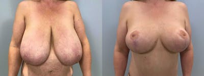 Breast Lift Before & After Gallery - Patient 47125706 - Image 1