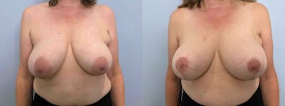 Breast Lift Before & After Gallery - Patient 47125739 - Image 1