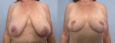 Breast Lift Before & After Gallery - Patient 47125791 - Image 1