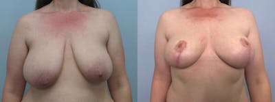 Breast Lift Before & After Gallery - Patient 47125839 - Image 1