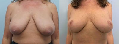 Breast Lift Before & After Gallery - Patient 47125890 - Image 1