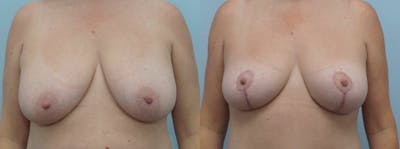 Breast Lift Gallery - Patient 47125951 - Image 1
