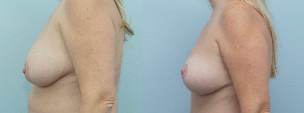 Breast Lift Gallery - Patient 47125951 - Image 3