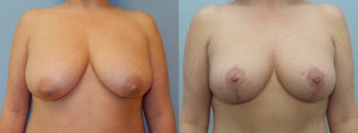 Breast Lift Before & After Gallery - Patient 47125997 - Image 1