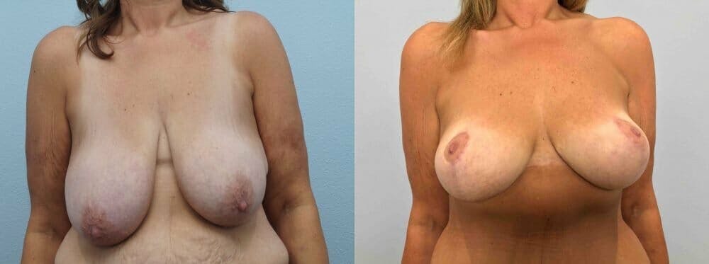Breast Lift