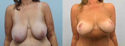 Breast Lift Before & After Gallery - Patient 47126010 - Image 1