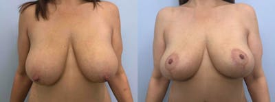 Breast Lift Before & After Gallery - Patient 47126071 - Image 1