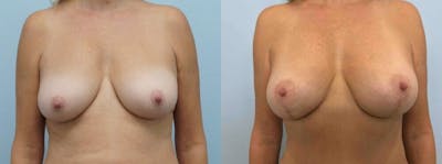 Breast Lift Before & After Gallery - Patient 47126119 - Image 1