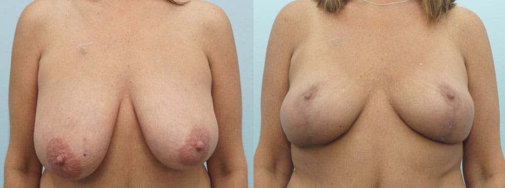 Breast Lift