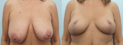 Breast Lift Before & After Gallery - Patient 47126172 - Image 1