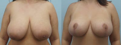 Breast Lift Before & After Gallery - Patient 47126212 - Image 1