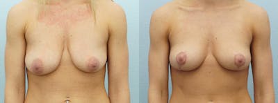 Breast Lift Before & After Gallery - Patient 47126238 - Image 1