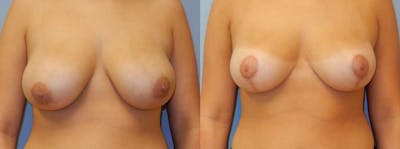 Breast Lift Gallery - Patient 47126246 - Image 1