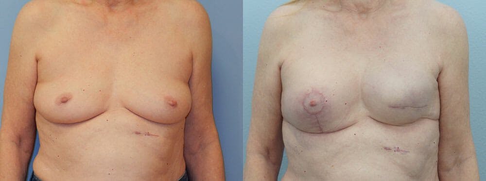 Breast Reconstruction