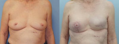Breast Reconstruction  Before & After Gallery - Patient 47146596 - Image 1