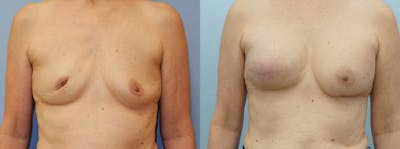 Breast Reconstruction  Before & After Gallery - Patient 47146644 - Image 1