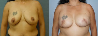 Breast Reconstruction  Before & After Gallery - Patient 47146666 - Image 1