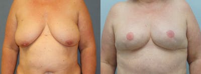 Breast Reconstruction  Before & After Gallery - Patient 47146682 - Image 1