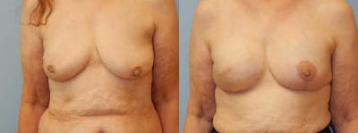 Breast Reconstruction  Before & After Gallery - Patient 47146695 - Image 1