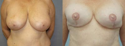 Breast Reconstruction  Before & After Gallery - Patient 47146719 - Image 1
