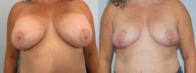 Breast Revision Before & After Gallery - Patient 47146927 - Image 1