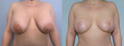 Breast Revision Before & After Gallery - Patient 47146941 - Image 1